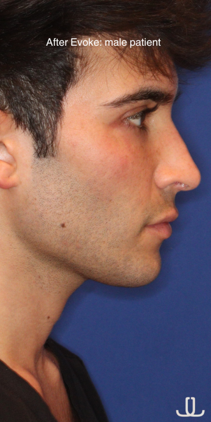 Evoke Before & After Patient #15738