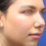 Evoke Before & After Patient #13898