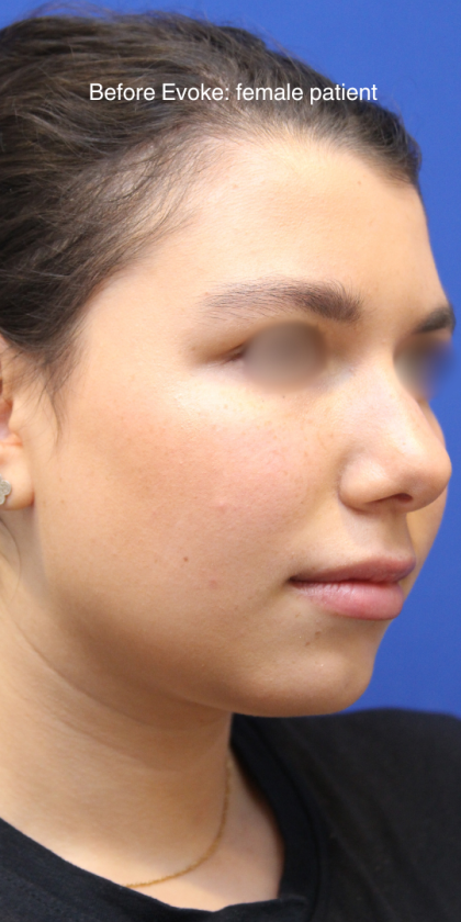 Evoke Before & After Patient #13898