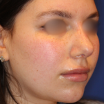 Evoke Before & After Patient #13898