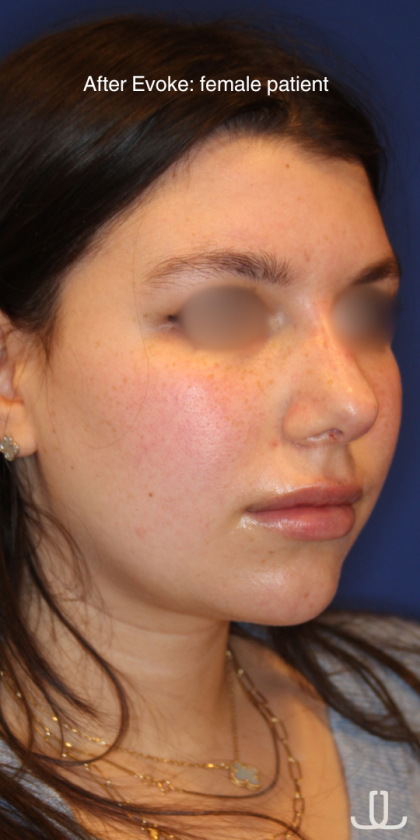 Evoke Before & After Patient #13898