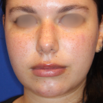 Evoke Before & After Patient #13898