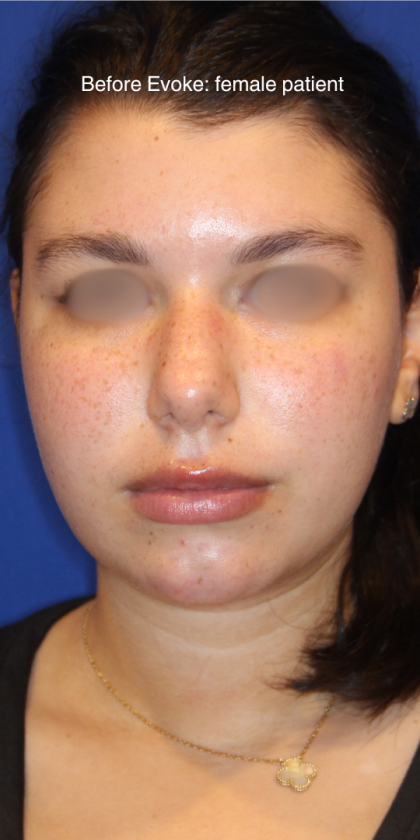 Evoke Before & After Patient #13898