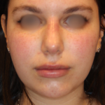 Evoke Before & After Patient #13898