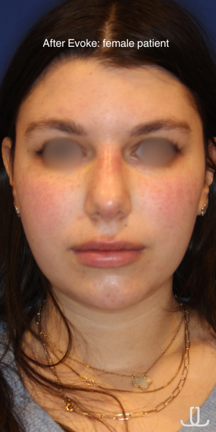 Evoke Before & After Patient #13898