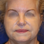 Facelift / Neck Lift Before & After Patient #15692