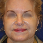 Facelift / Neck Lift Before & After Patient #15692