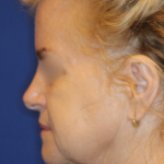Facelift / Neck Lift Before & After Patient #15692
