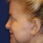 Facelift / Neck Lift Before & After Patient #15692
