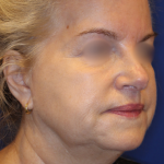Facelift / Neck Lift Before & After Patient #15692