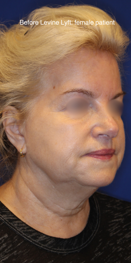 Facelift / Neck Lift Before & After Patient #15692