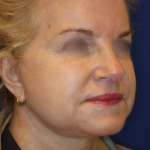 Facelift / Neck Lift Before & After Patient #15692
