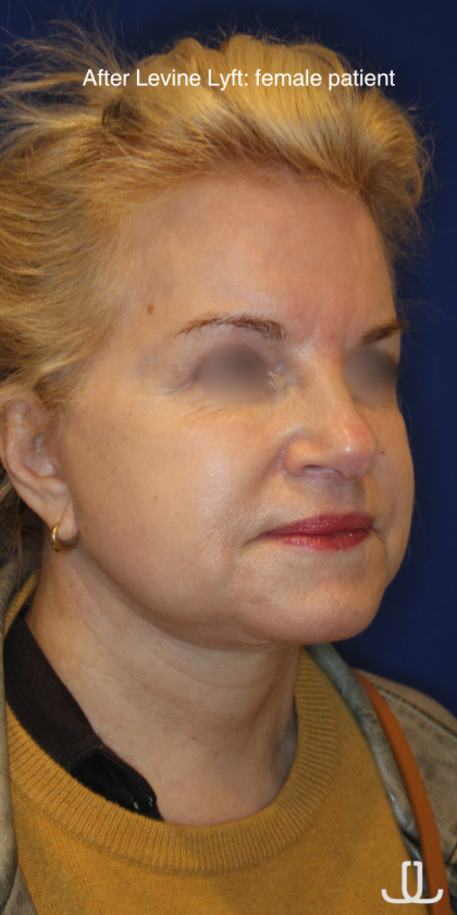 Facelift / Neck Lift Before & After Patient #15692