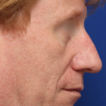 Facelift / Neck Lift Before & After Patient #15103