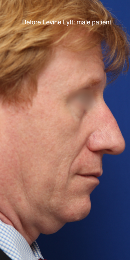 Facelift / Neck Lift Before & After Patient #15103