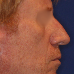 Facelift / Neck Lift Before & After Patient #15103