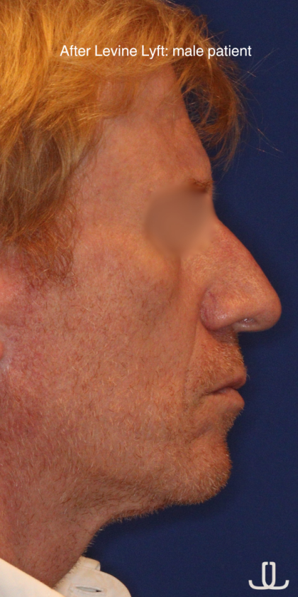 Facelift / Neck Lift Before & After Patient #15103