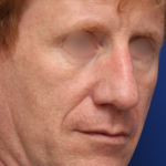 Facelift / Neck Lift Before & After Patient #15103