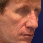 Facelift / Neck Lift Before & After Patient #15103