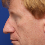 Facelift / Neck Lift Before & After Patient #15103
