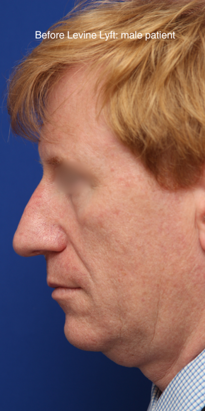 Facelift / Neck Lift Before & After Patient #15103