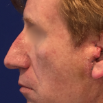 Facelift / Neck Lift Before & After Patient #15103