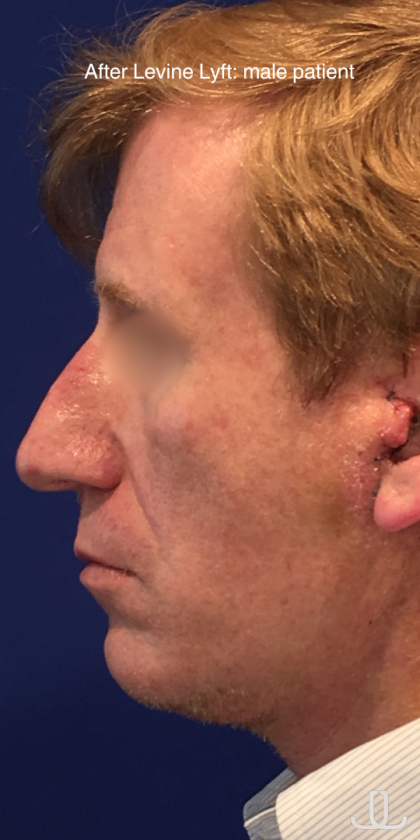 Facelift / Neck Lift Before & After Patient #15103