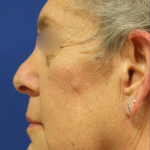 Facelift / Neck Lift Before & After Patient #15098