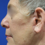 Facelift / Neck Lift Before & After Patient #15098
