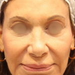 Facelift / Neck Lift Before & After Patient #15096