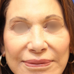 Facelift / Neck Lift Before & After Patient #15096