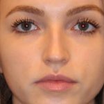 Dermal Fillers Before & After Patient #15712