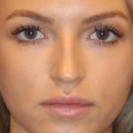 Dermal Fillers Before & After Patient #15712