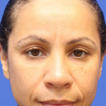 Dermal Fillers Before & After Patient #15574
