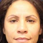 Dermal Fillers Before & After Patient #15574