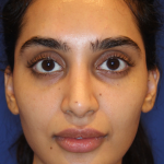 Dermal Fillers Before & After Patient #13856