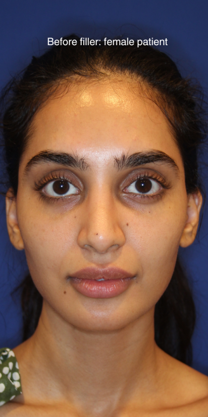 Dermal Fillers Before & After Patient #13856
