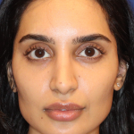 Dermal Fillers Before & After Patient #13856