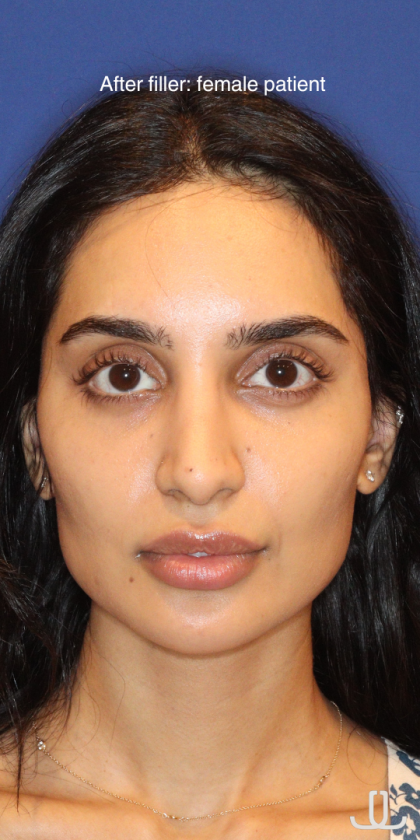 Dermal Fillers Before & After Patient #13856