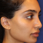 Dermal Fillers Before & After Patient #13856