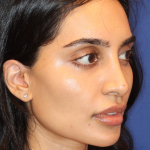 Dermal Fillers Before & After Patient #13856