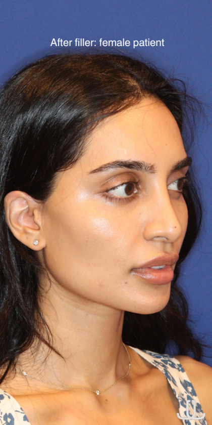 Dermal Fillers Before & After Patient #13856