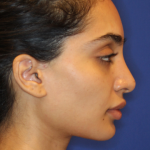 Dermal Fillers Before & After Patient #13856