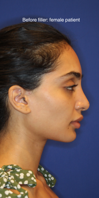 Dermal Fillers Before & After Patient #13856