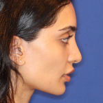 Dermal Fillers Before & After Patient #13856