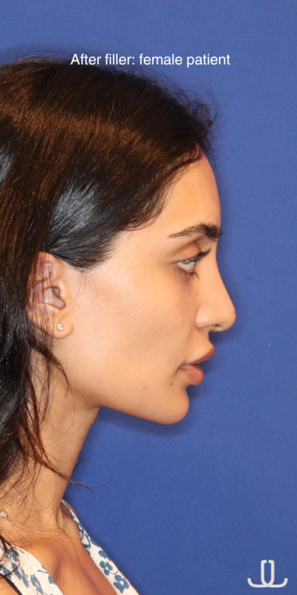 Dermal Fillers Before & After Patient #13856