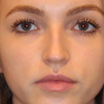 Lip Filler Before & After Patient #13833