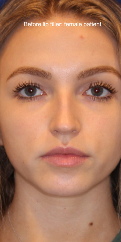 Lip Filler Before & After Patient #13833