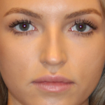 Lip Filler Before & After Patient #13833