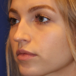 Lip Filler Before & After Patient #13833